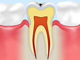 初期虫歯C0