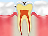 エナメル質の虫歯C1