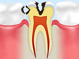 象牙質の虫歯C2