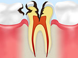 神経まで達した虫歯C3