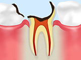 歯根まで達した虫歯C4